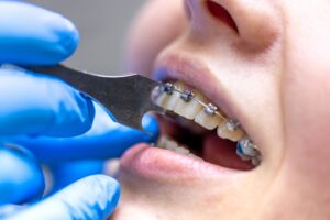 Orthodontic Treatment in Kolkata